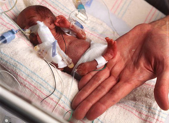 15 مليون ولادة مبكرة سنوياً..خطر يمكن الوقاية منه