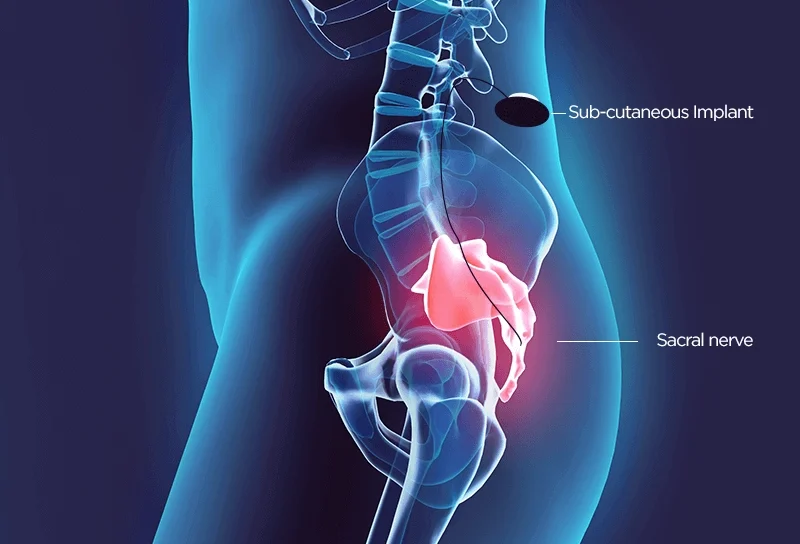 نجاح أول جراحة لتحفيز العصب العجزي بجامعة عين شمس إنجاز طبي يعيد الأمل لطفل عانى سنوات المرض نجاح أول جراحة لتحفيز العصب العجزي بجامعة عين شمس إنجاز طبي يعيد الأمل لطفل عانى سنوات المرض