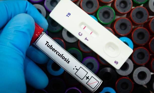 147 مليون يورو لدعم أبحاث الصحة العالمية.. دفعة جديدة لمواجهة السل والأوبئة وتغير المناخ